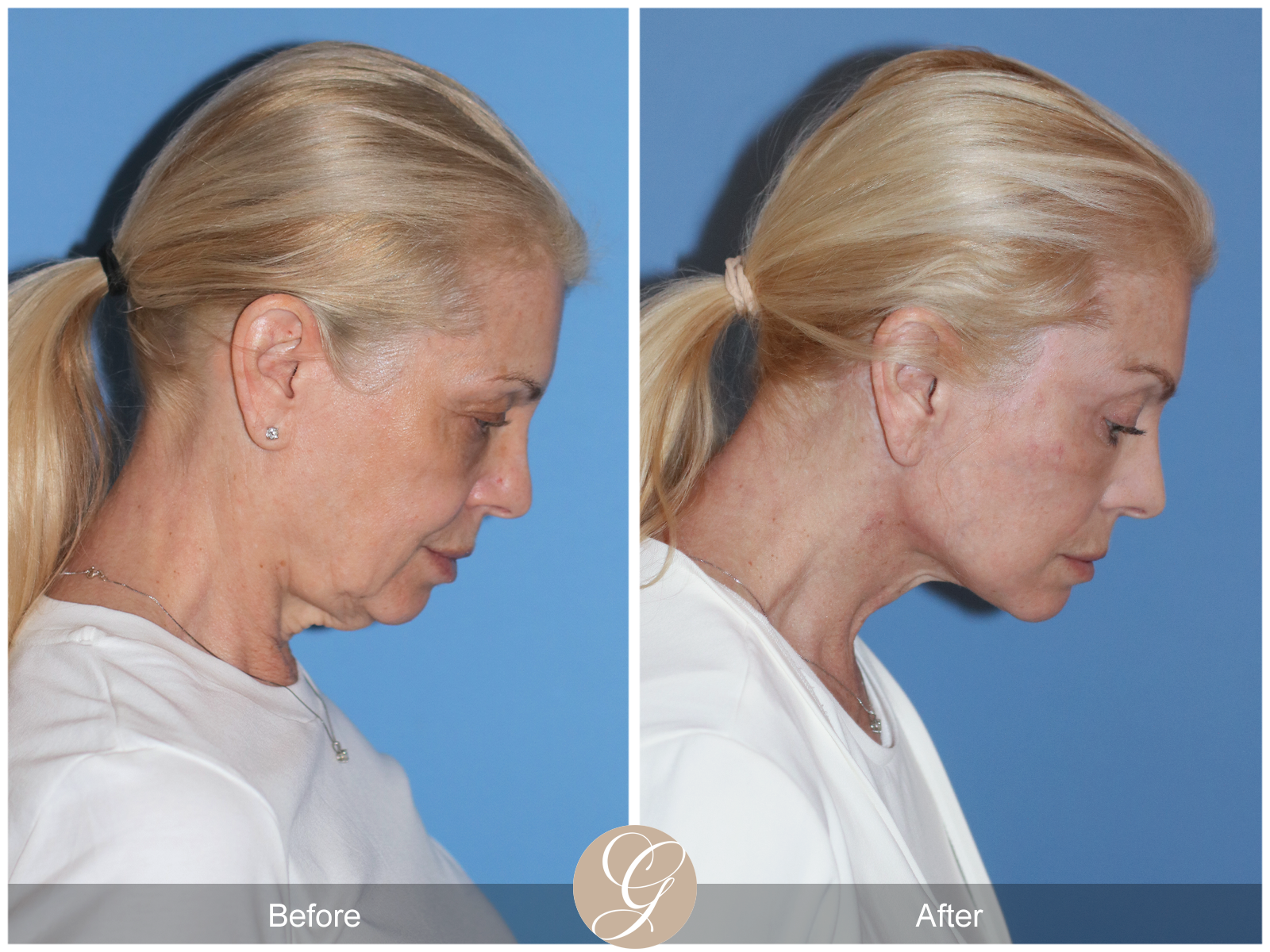 Preservation Deep Plane Facelift Case 26 Image