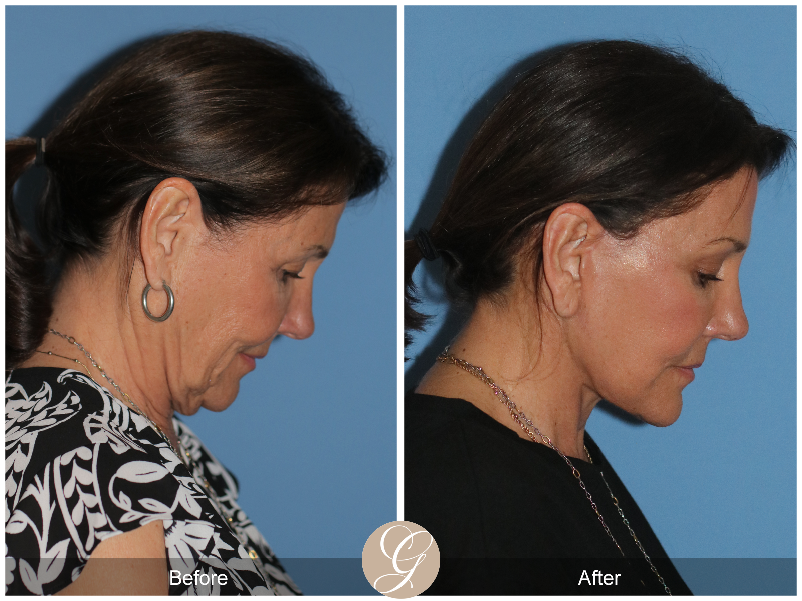 Preservation Deep Plane Facelift Case 25 Image