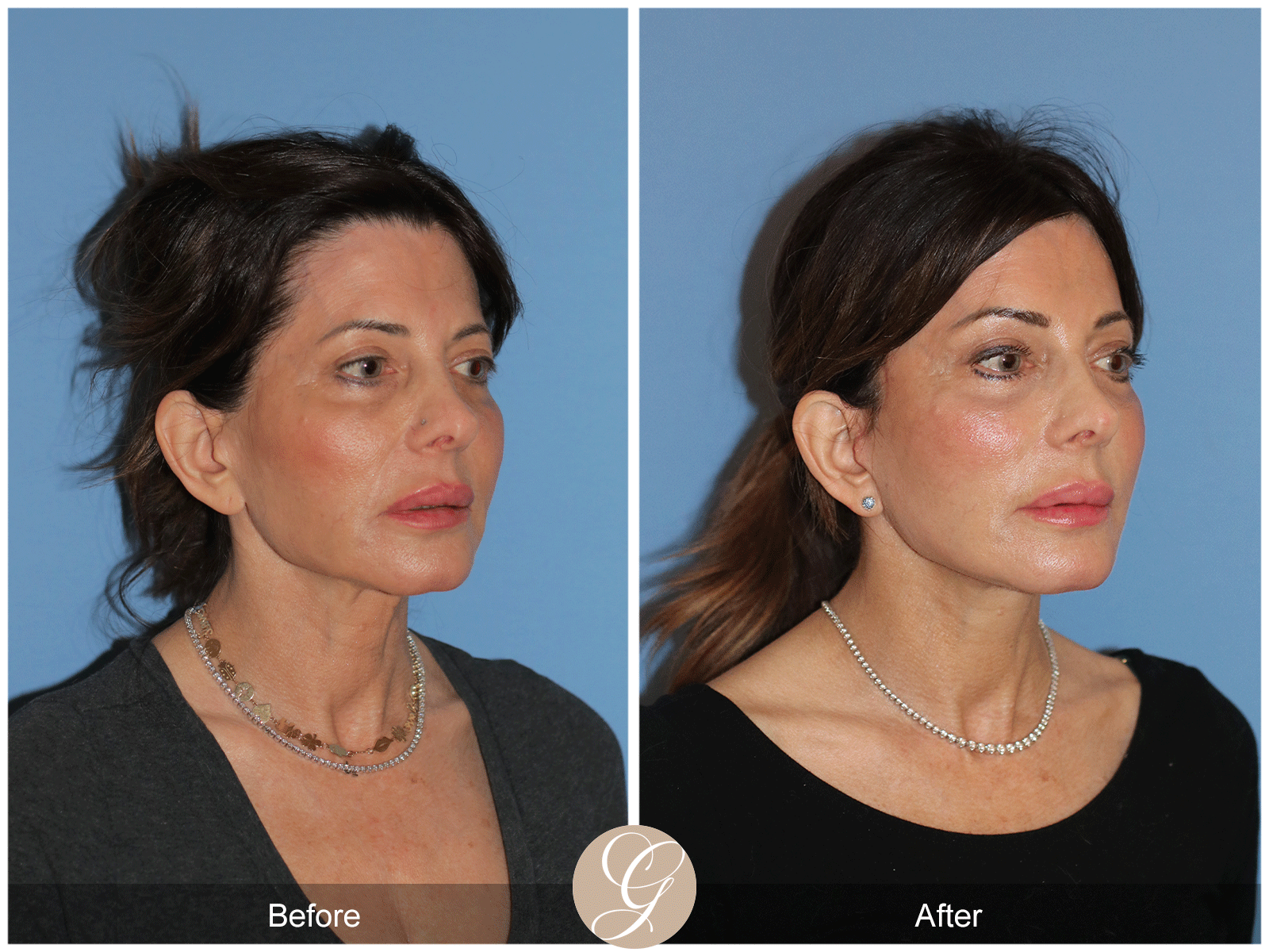 Preservation Deep Plane Facelift Case 27 Image