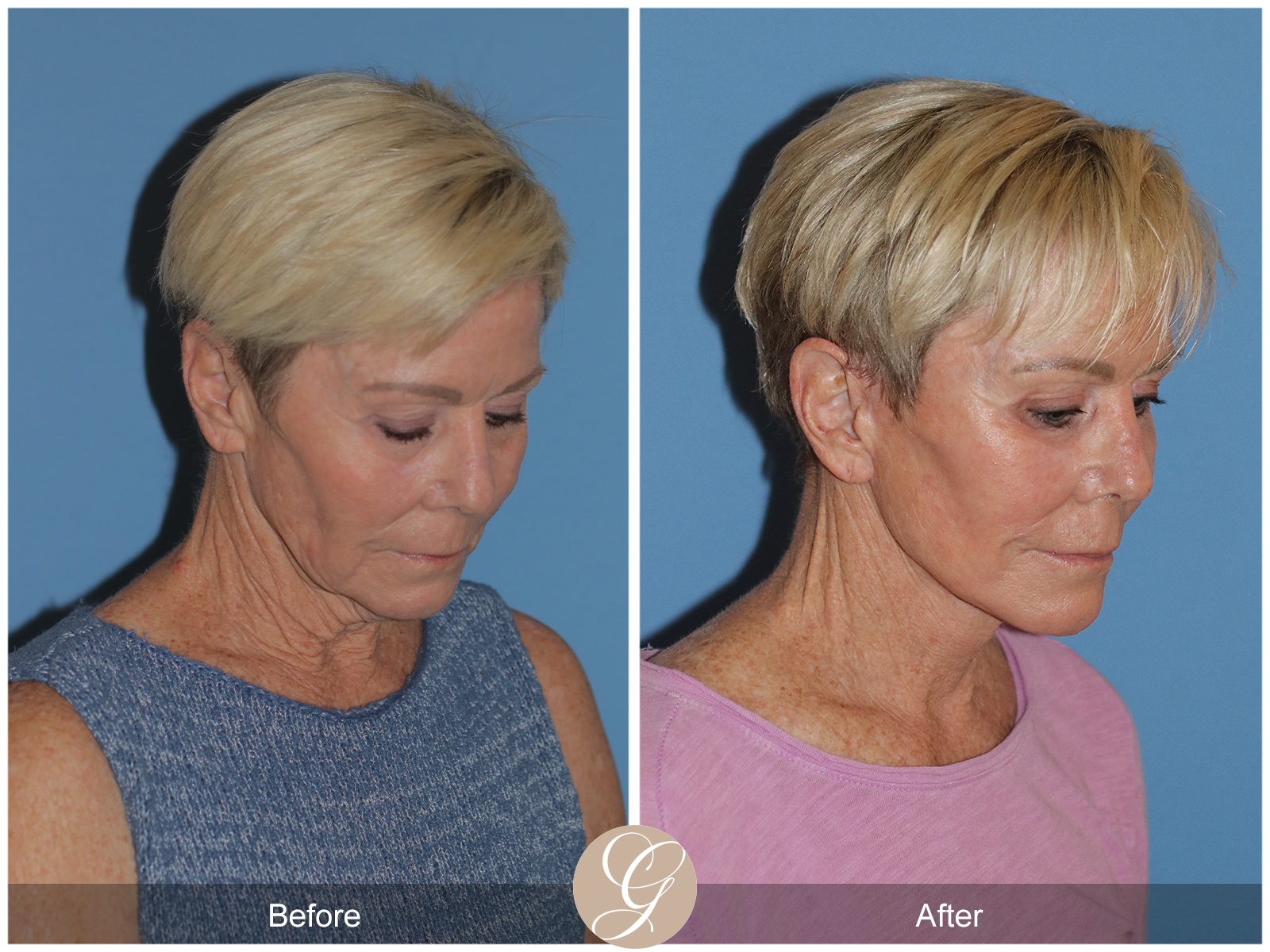 Preservation Deep Plane Facelift Case 28 Image