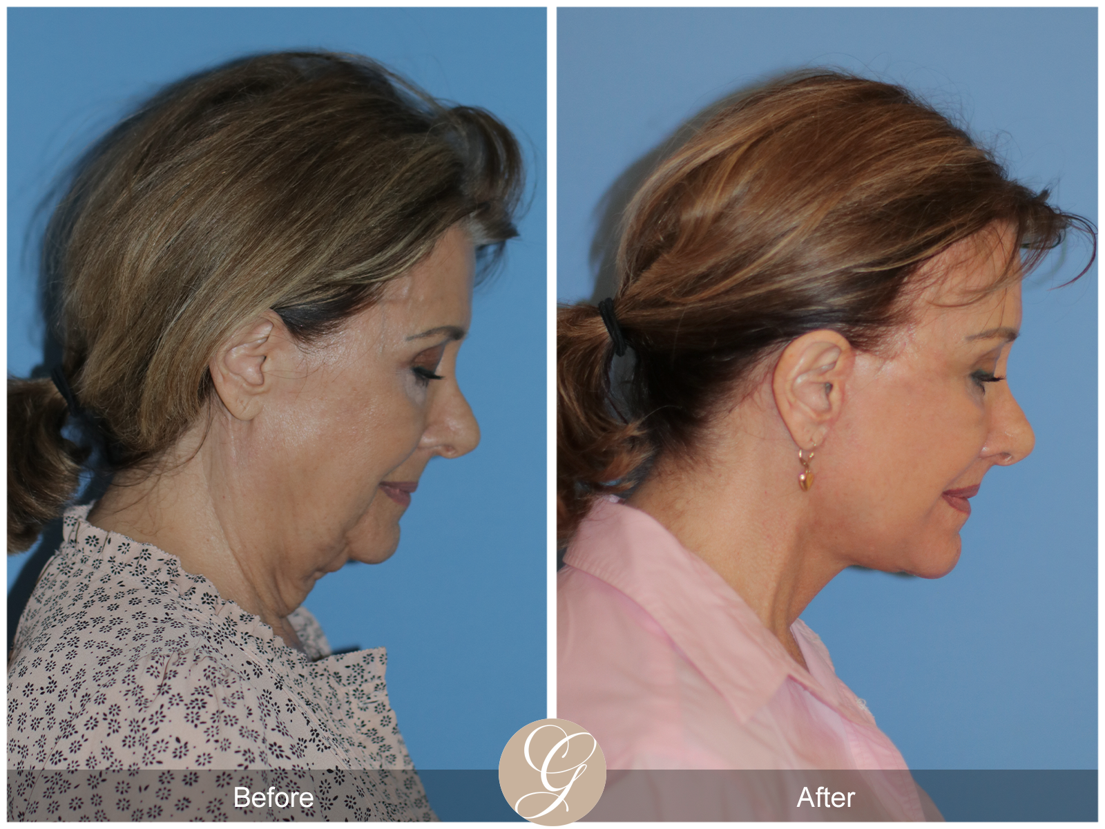 Preservation Deep Plane Facelift Case 30 Image