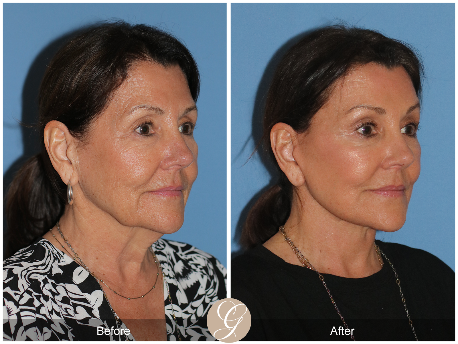 Preservation Deep Plane Facelift Case 25 Image