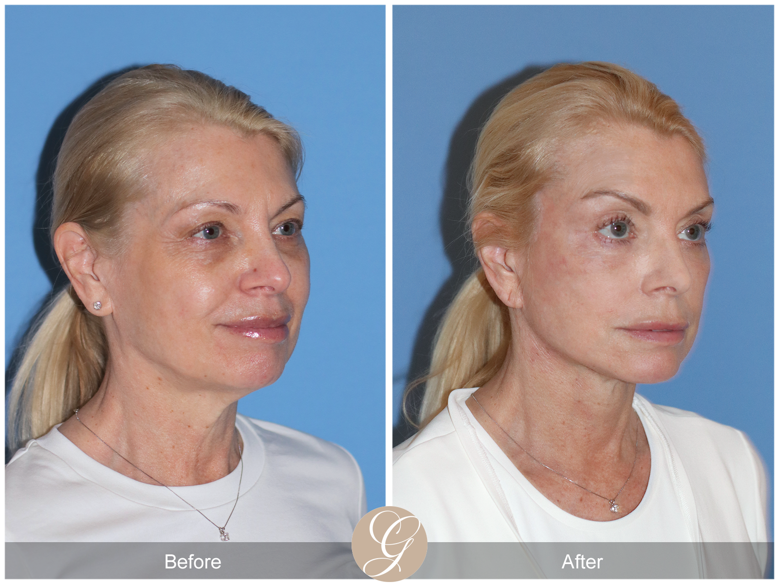 Preservation Deep Plane Facelift Case 26 Image