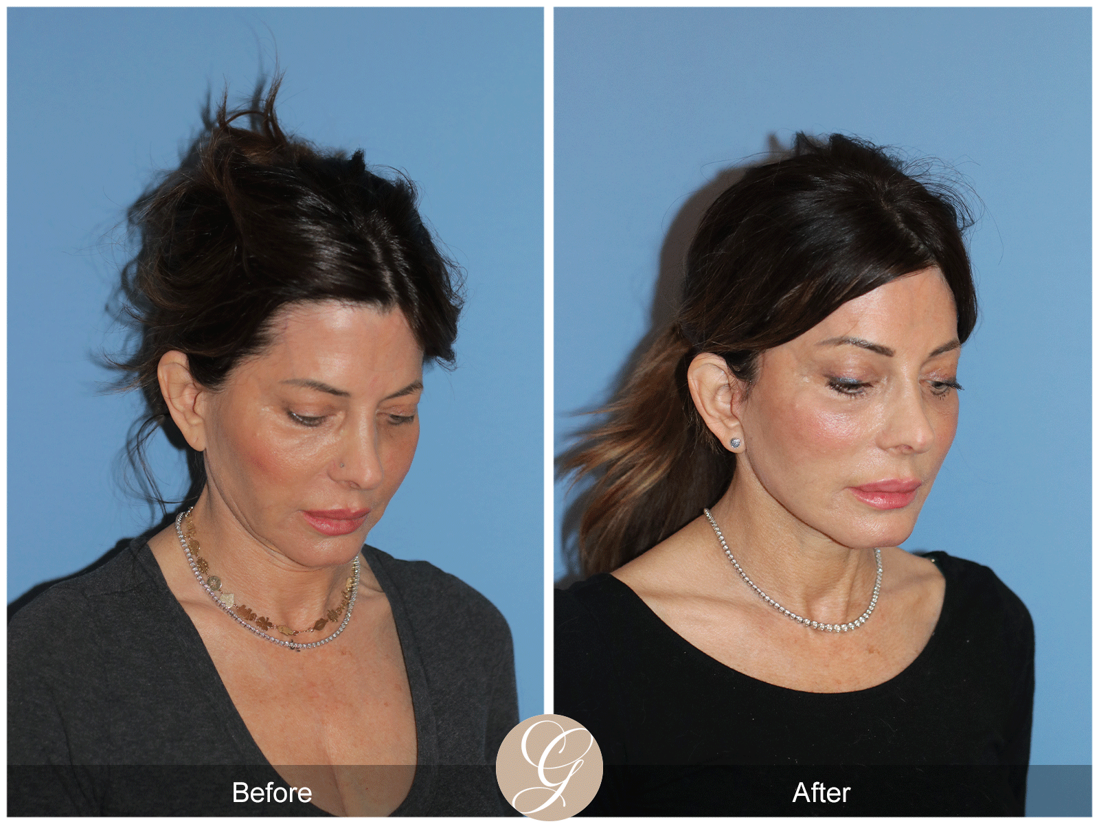 Preservation Deep Plane Facelift Case 27 Image