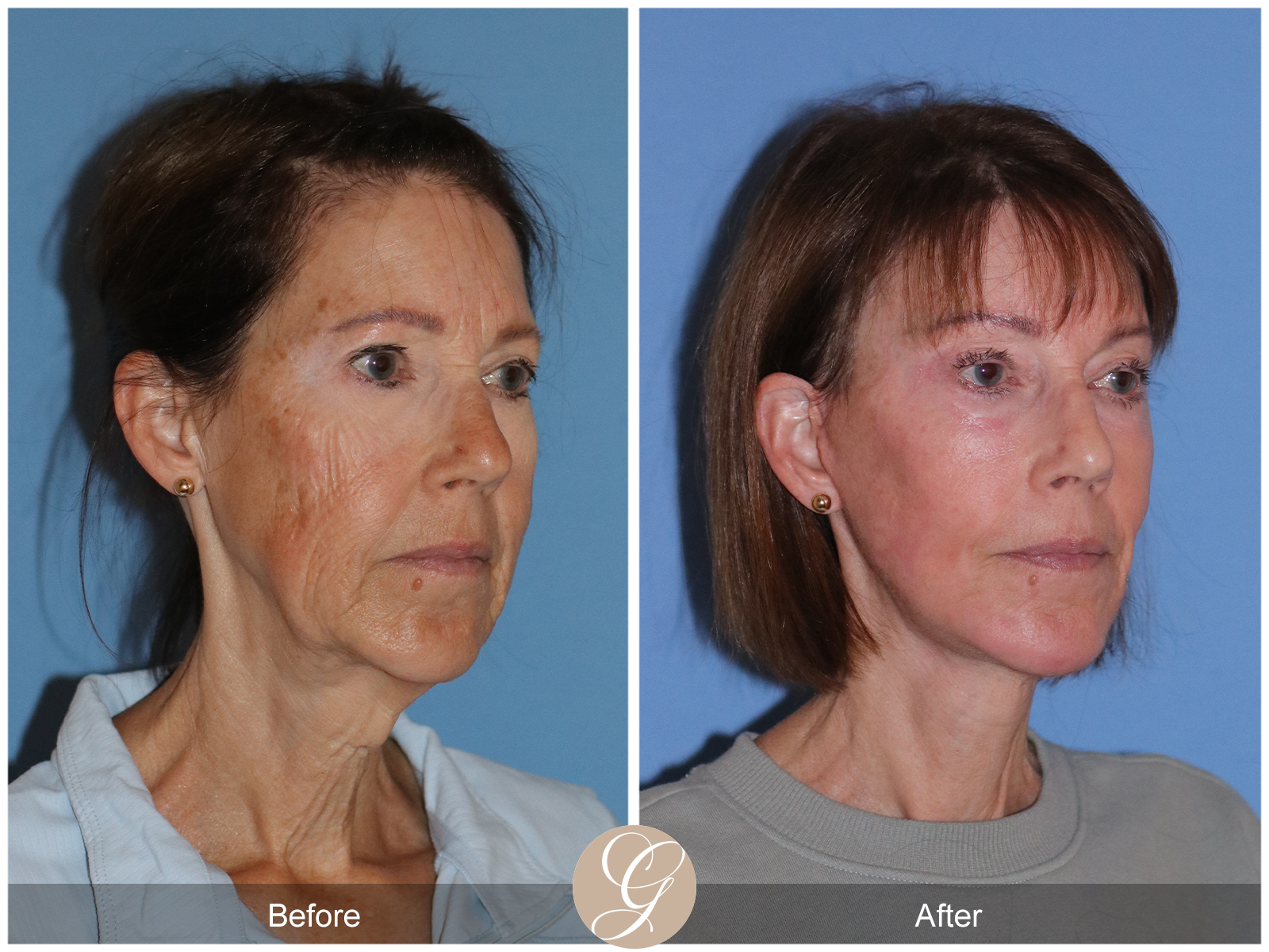 Preservation Deep Plane Facelift Case 32 Image