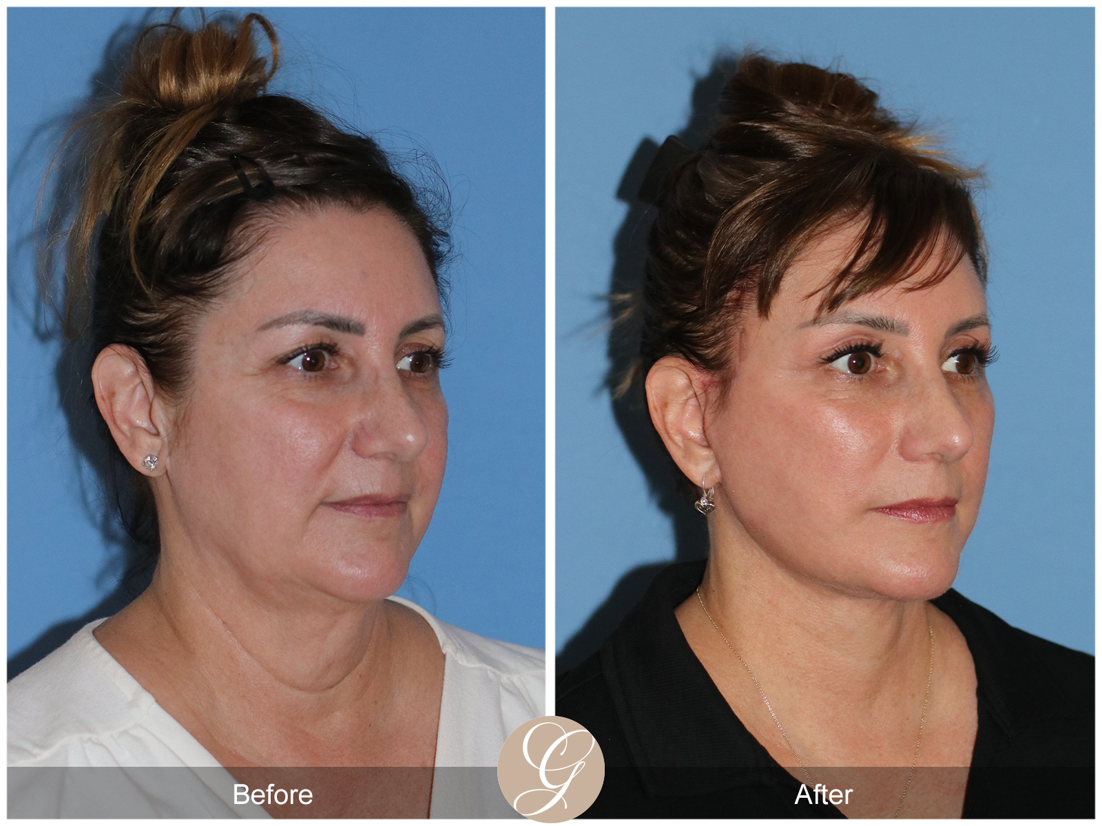 Preservation Deep Plane Facelift Case 33 Image