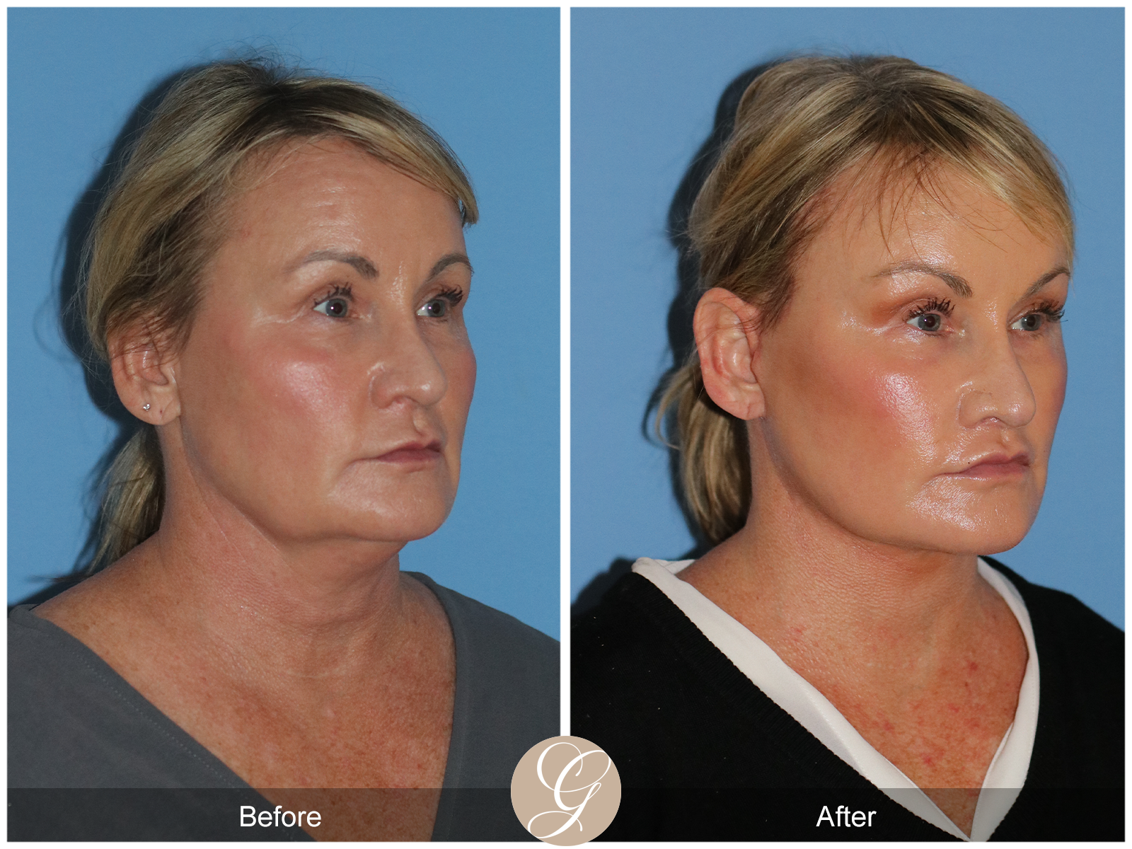 Preservation Deep Plane Facelift Case 34 Image