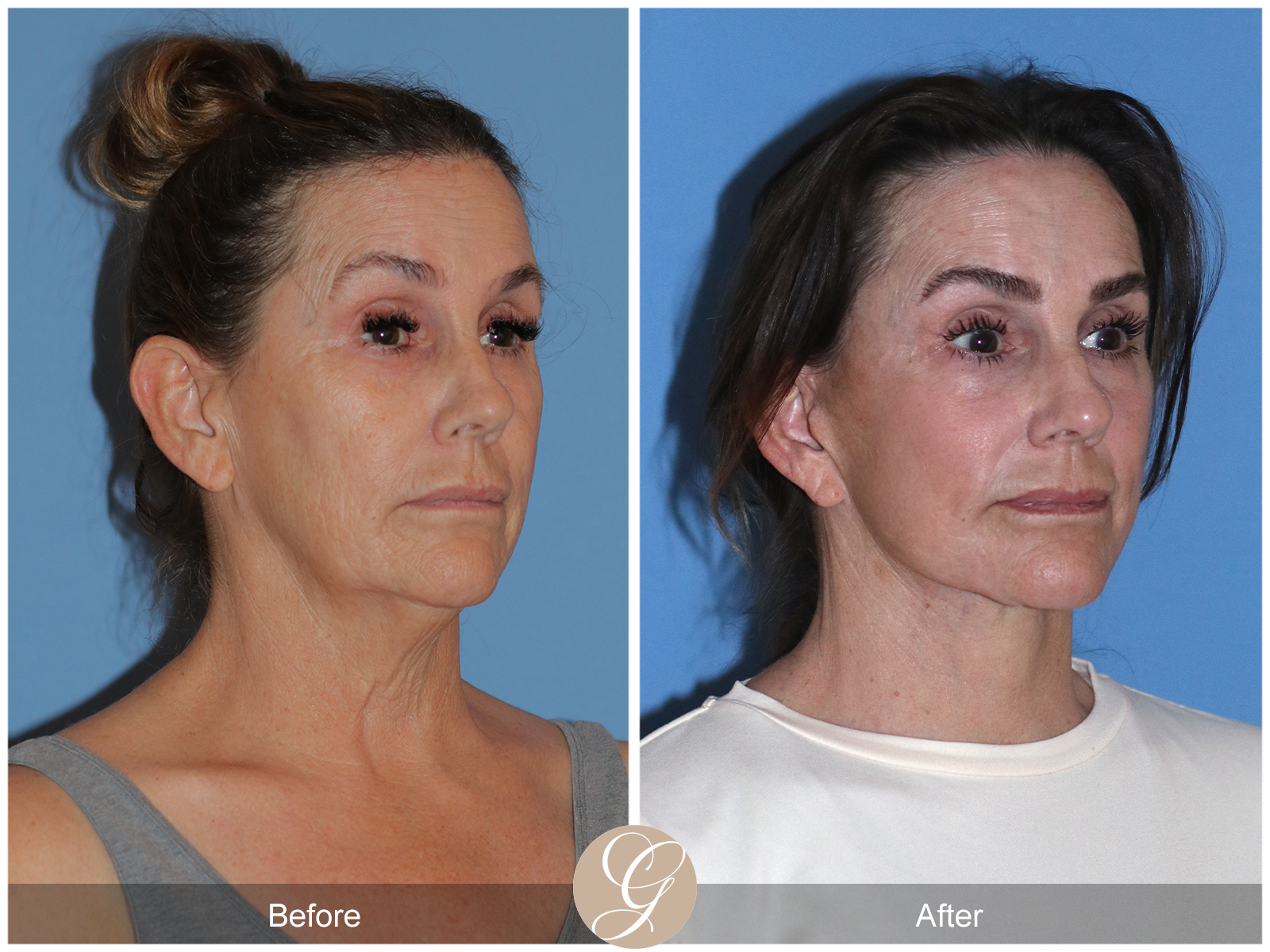 Deep Plane Facelift Case 25 Image