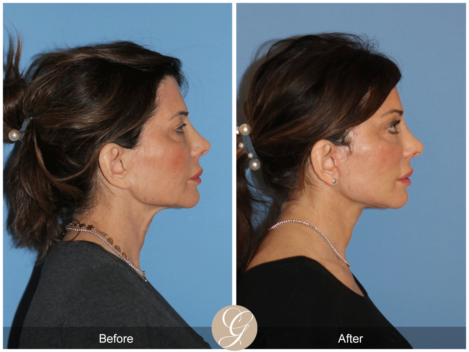 Preservation Deep Plane Facelift Case 27 Image