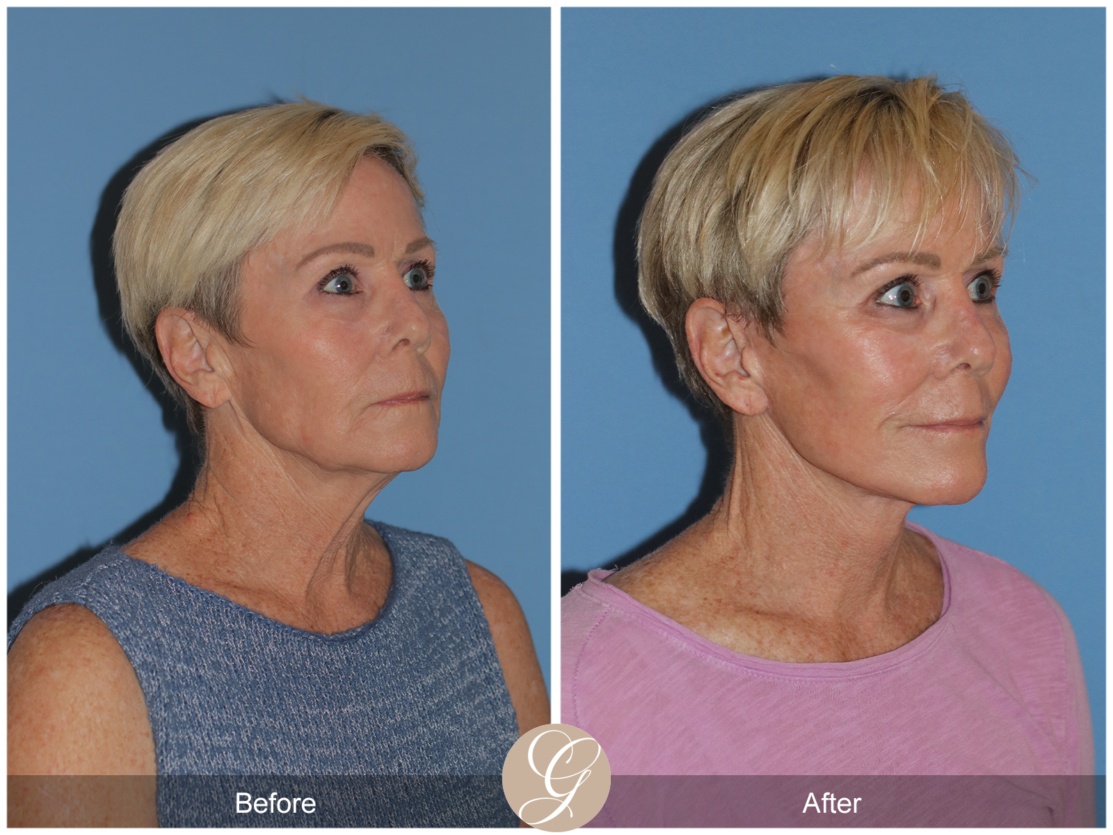 Preservation Deep Plane Facelift Case 28 Image