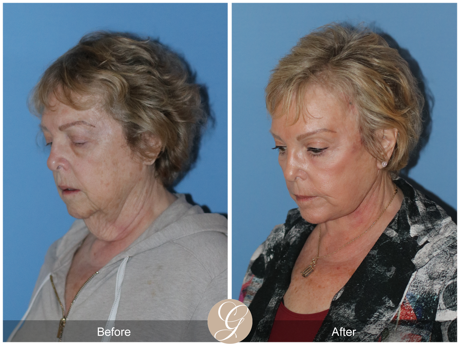 Preservation Deep Plane Facelift Case 31 Image