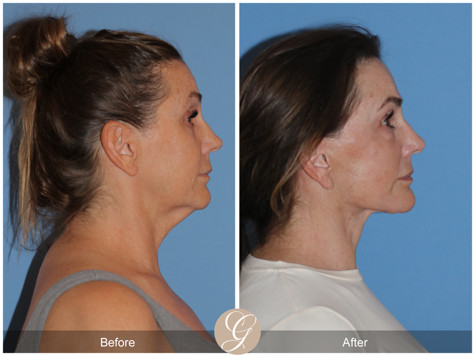 Deep Plane Facelift Case 25 Image