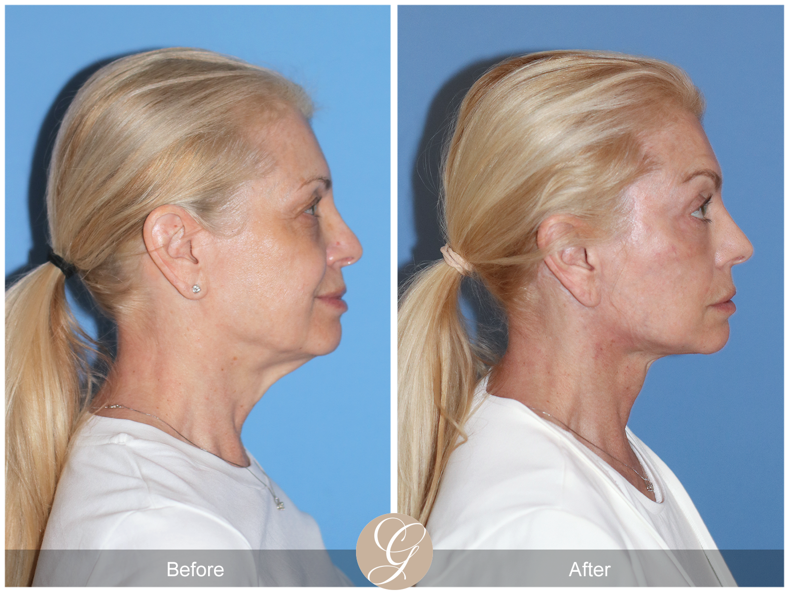 Preservation Deep Plane Facelift Case 26 Image