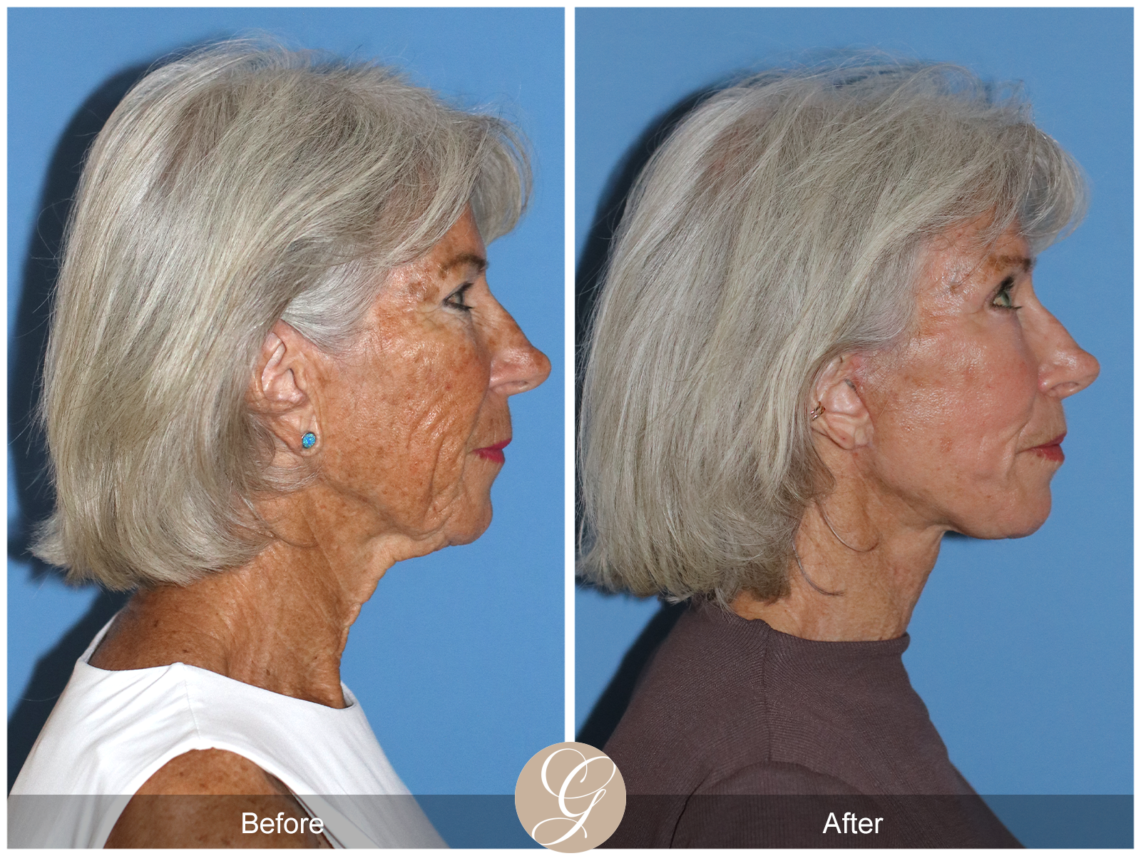 Preservation Deep Plane Facelift Case 24 Image