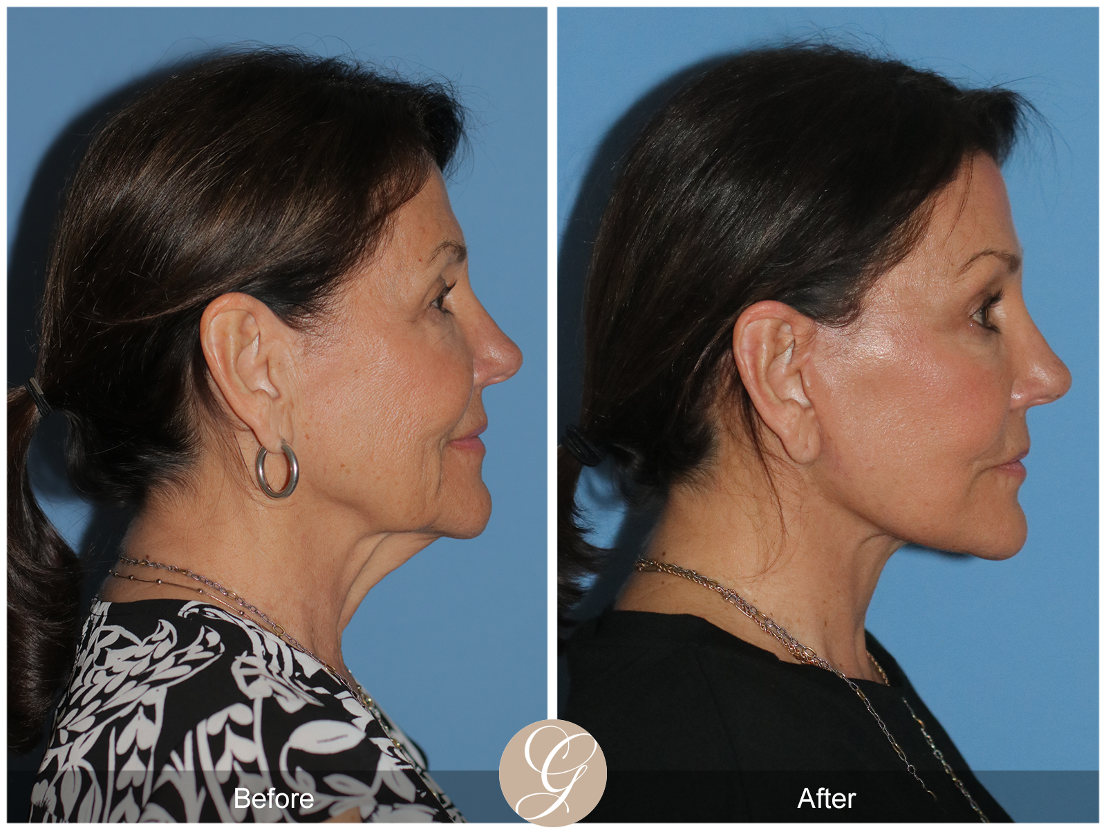 Preservation Deep Plane Facelift Case 25 Image