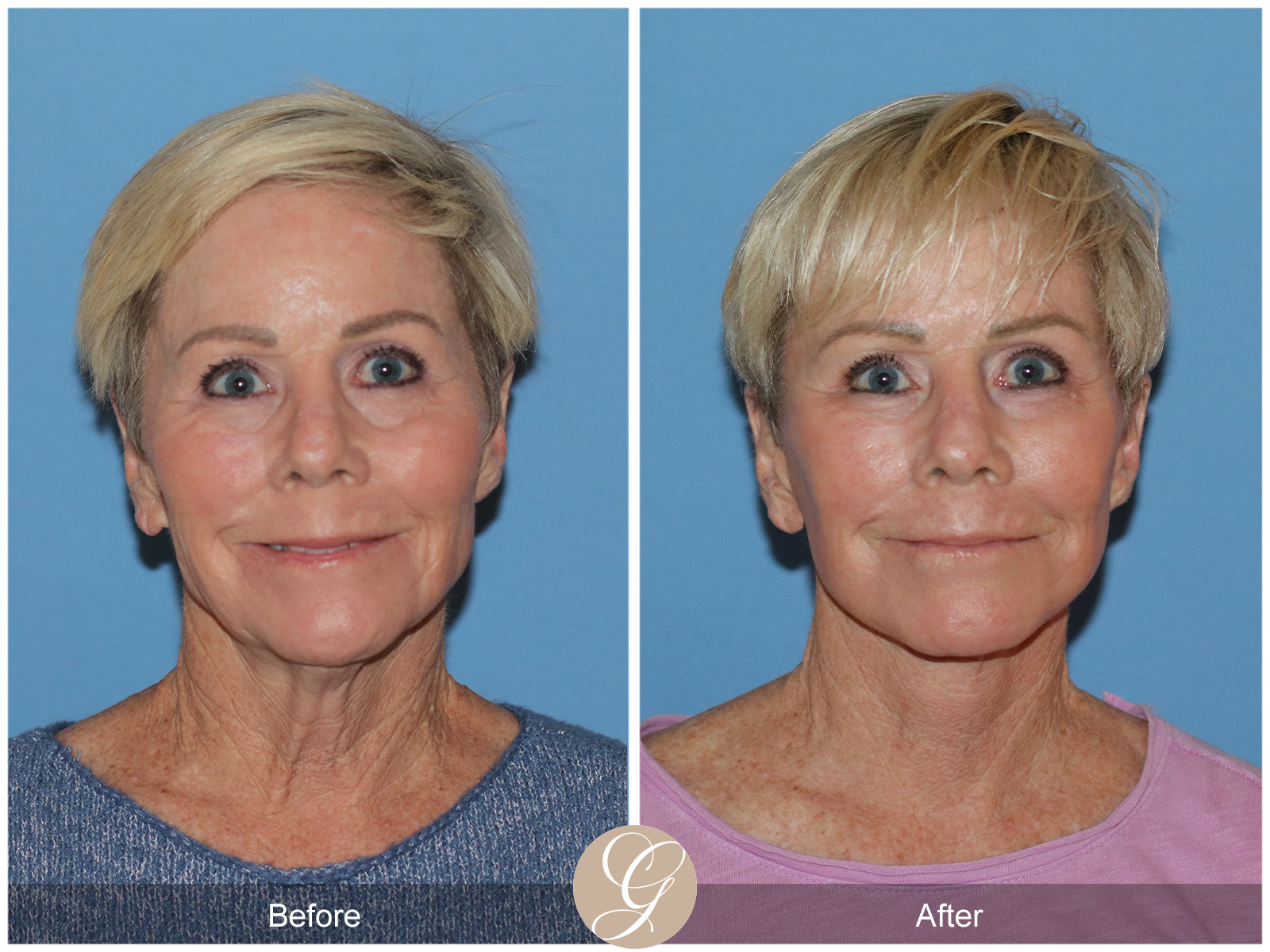 Preservation Deep Plane Facelift Case 28 Image