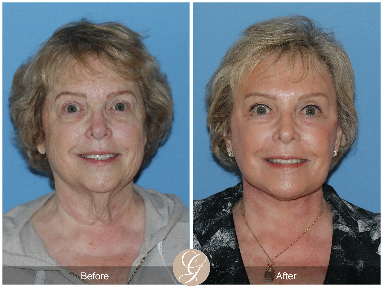 Preservation Deep Plane Facelift Case 31 Image