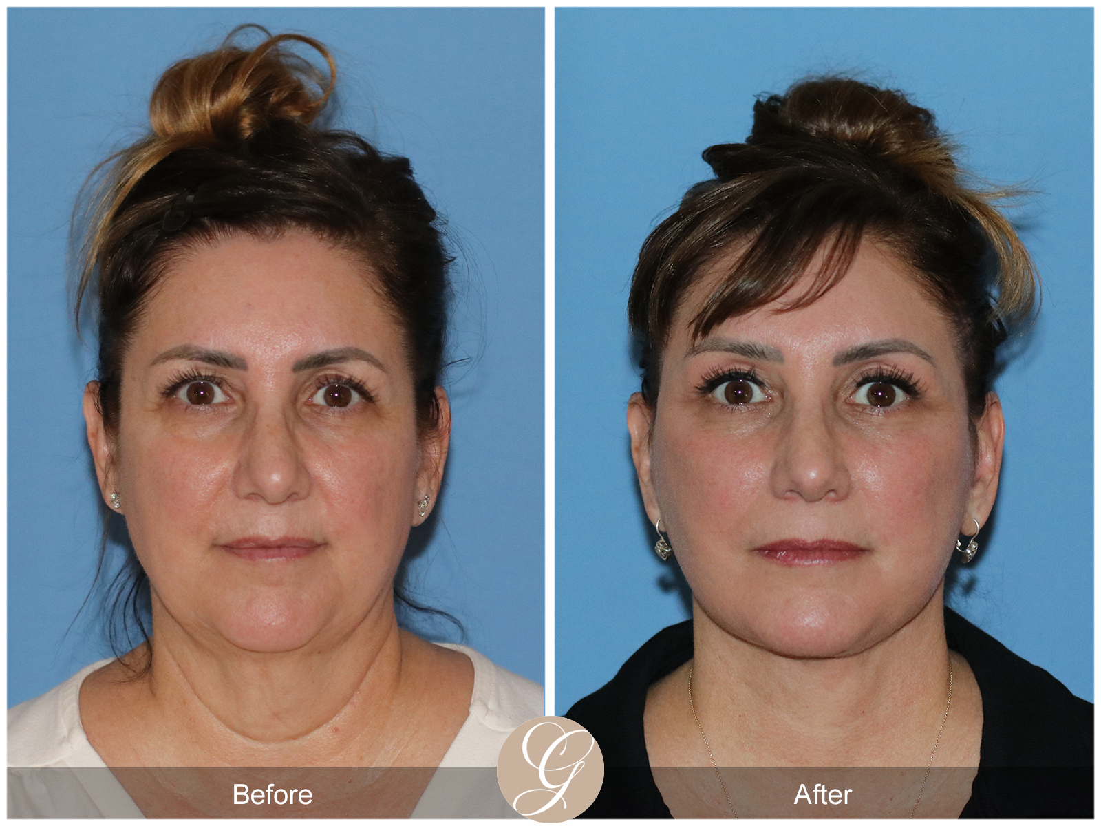 Preservation Deep Plane Facelift Case 33 Image