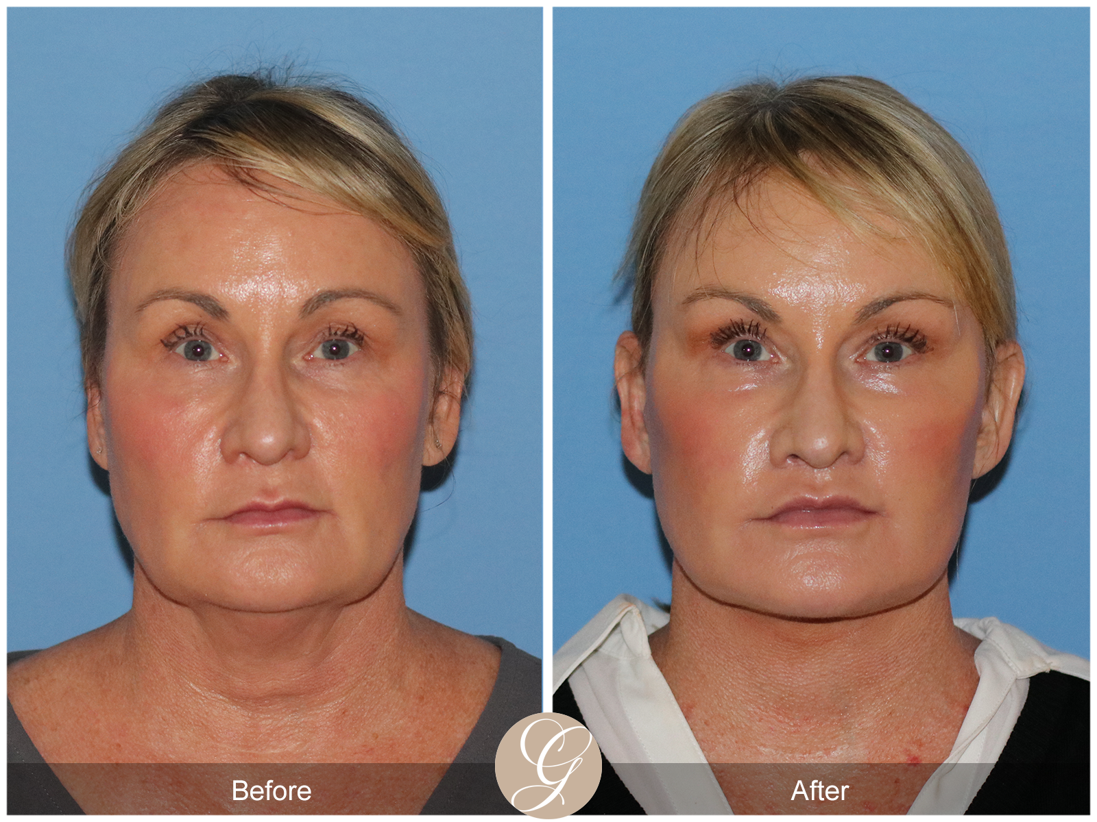 Preservation Deep Plane Facelift Case 34 Image