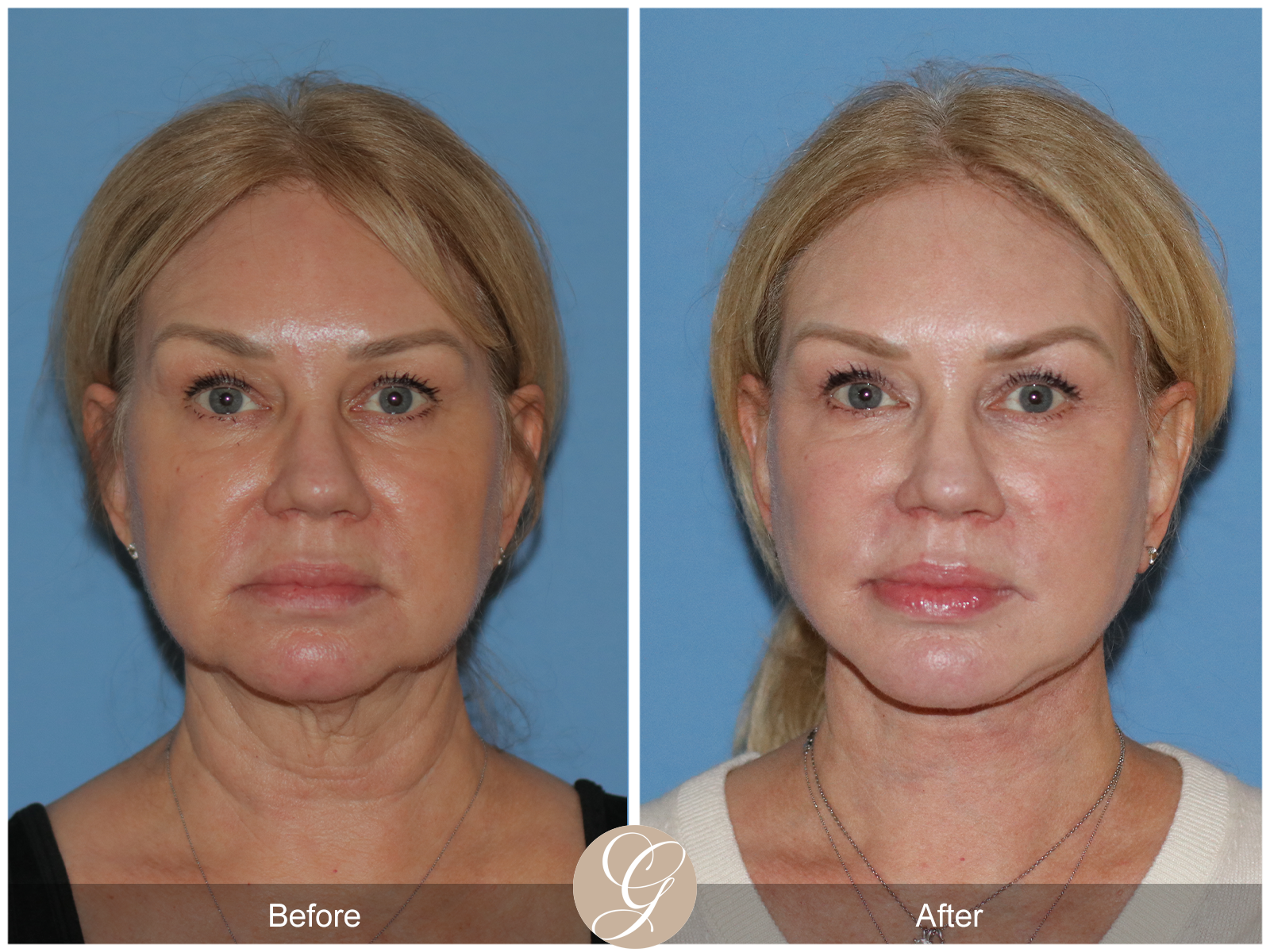 Deep Plane Facelift Case 26 Image