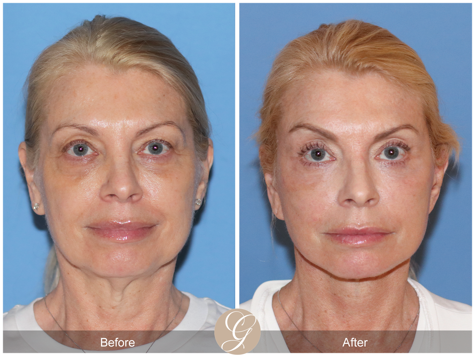 Preservation Deep Plane Facelift Case 26 Image