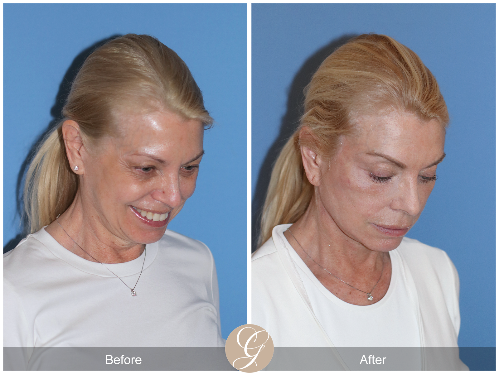 Preservation Deep Plane Facelift Case 26 Image