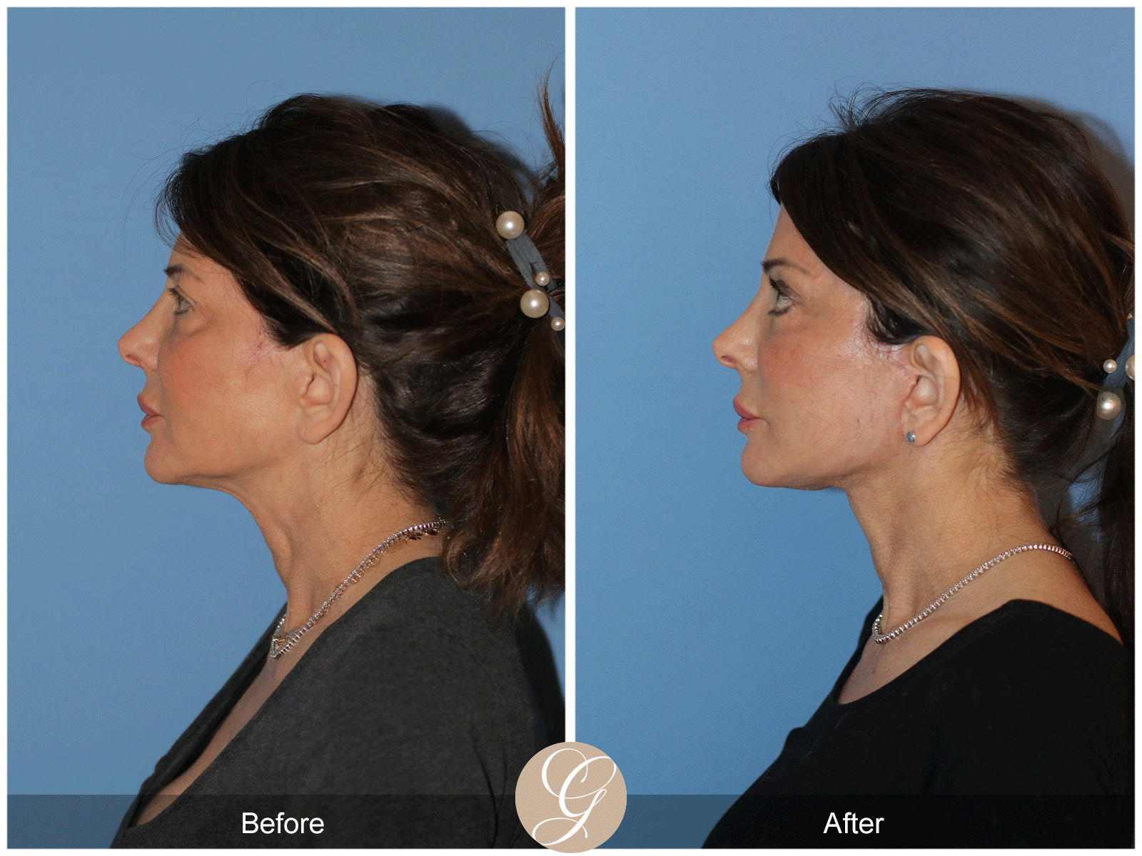 Preservation Deep Plane Facelift Case 27 Image