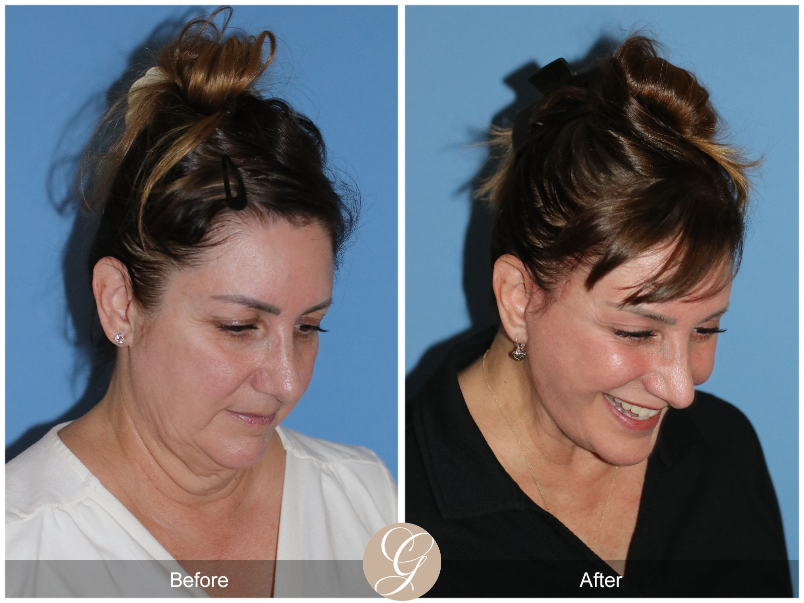 Preservation Deep Plane Facelift Case 33 Image