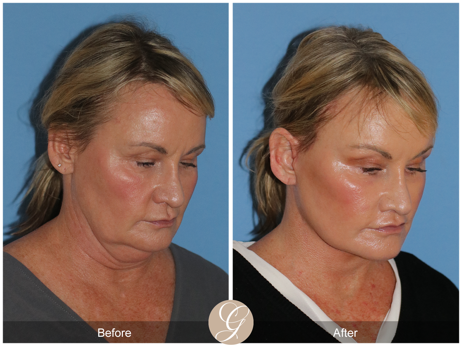 Preservation Deep Plane Facelift Case 34 Image