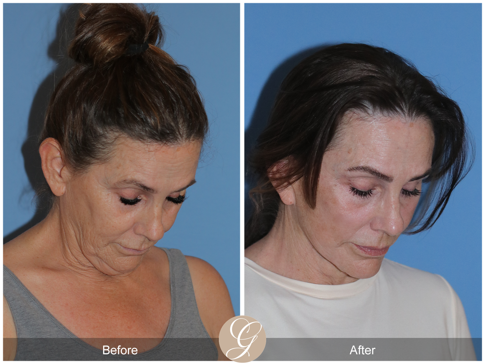 Deep Plane Facelift Case 25 Image