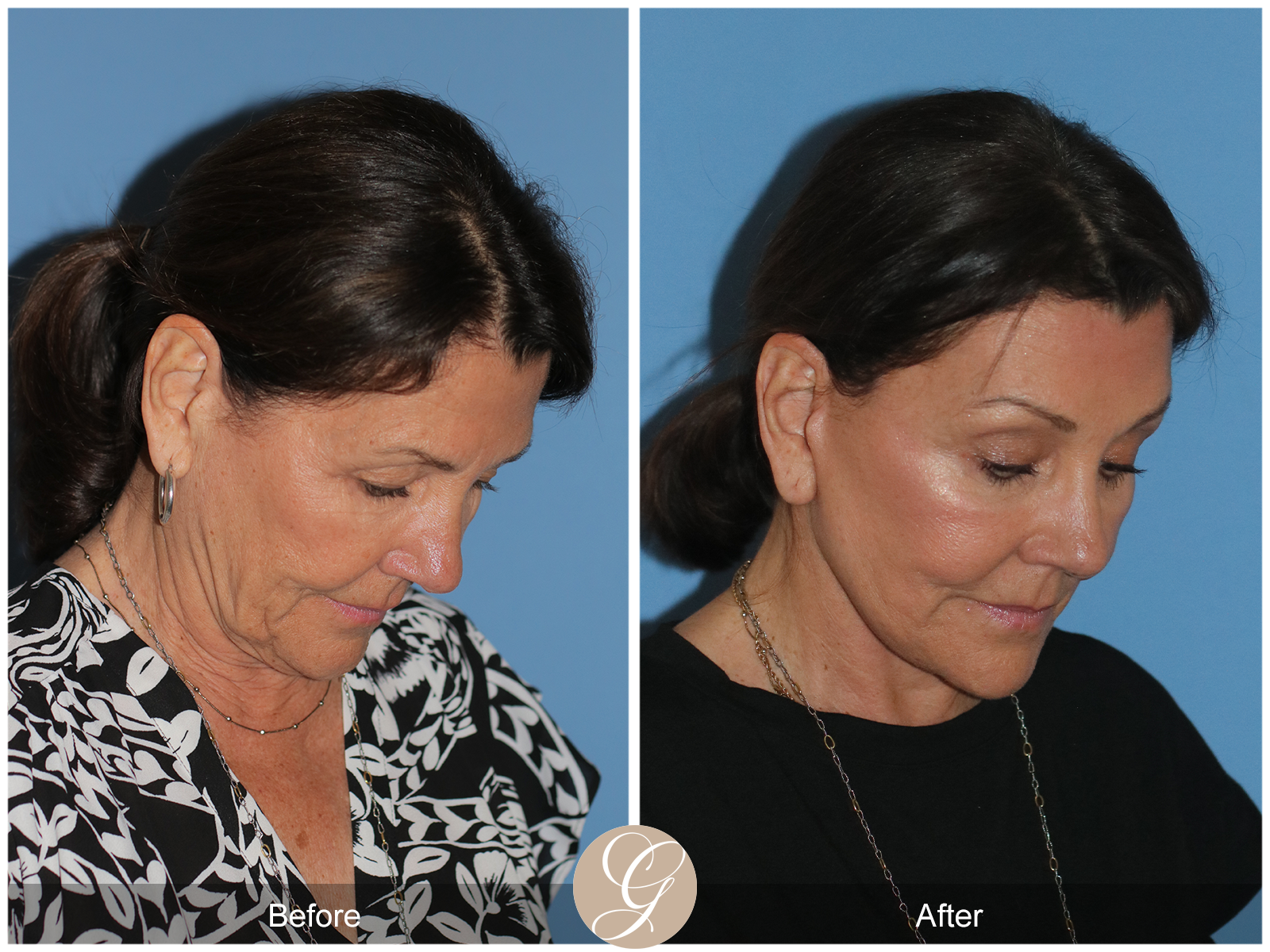 Preservation Deep Plane Facelift Case 25 Image