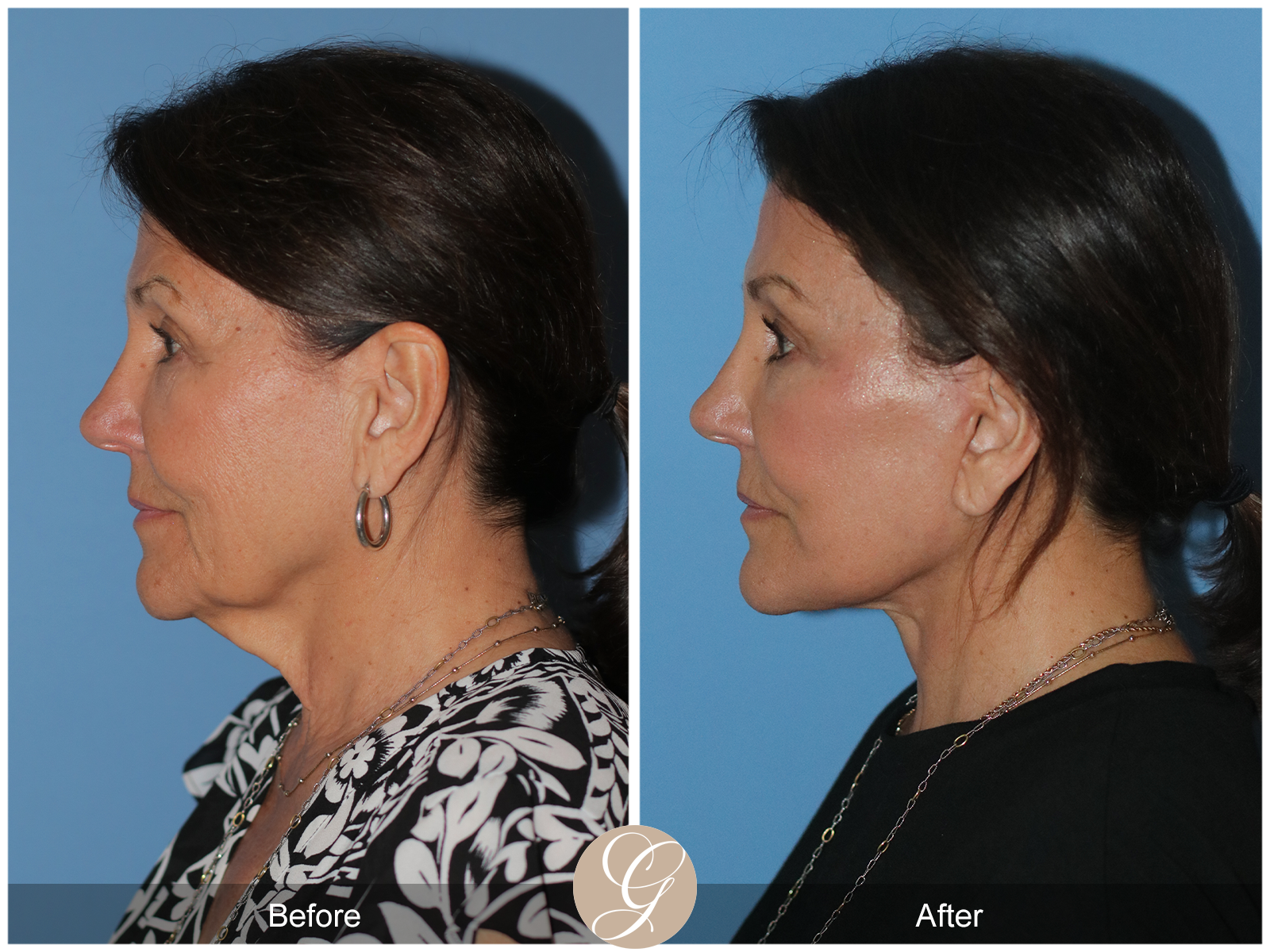 Preservation Deep Plane Facelift Case 25 Image