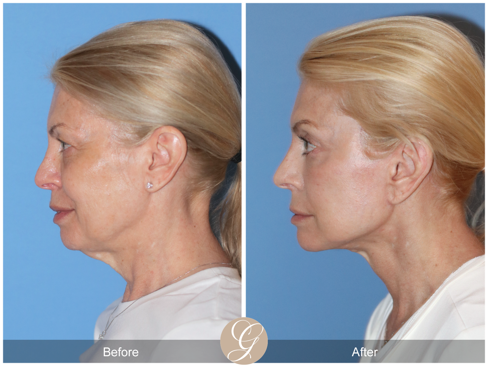 Preservation Deep Plane Facelift Case 26 Image