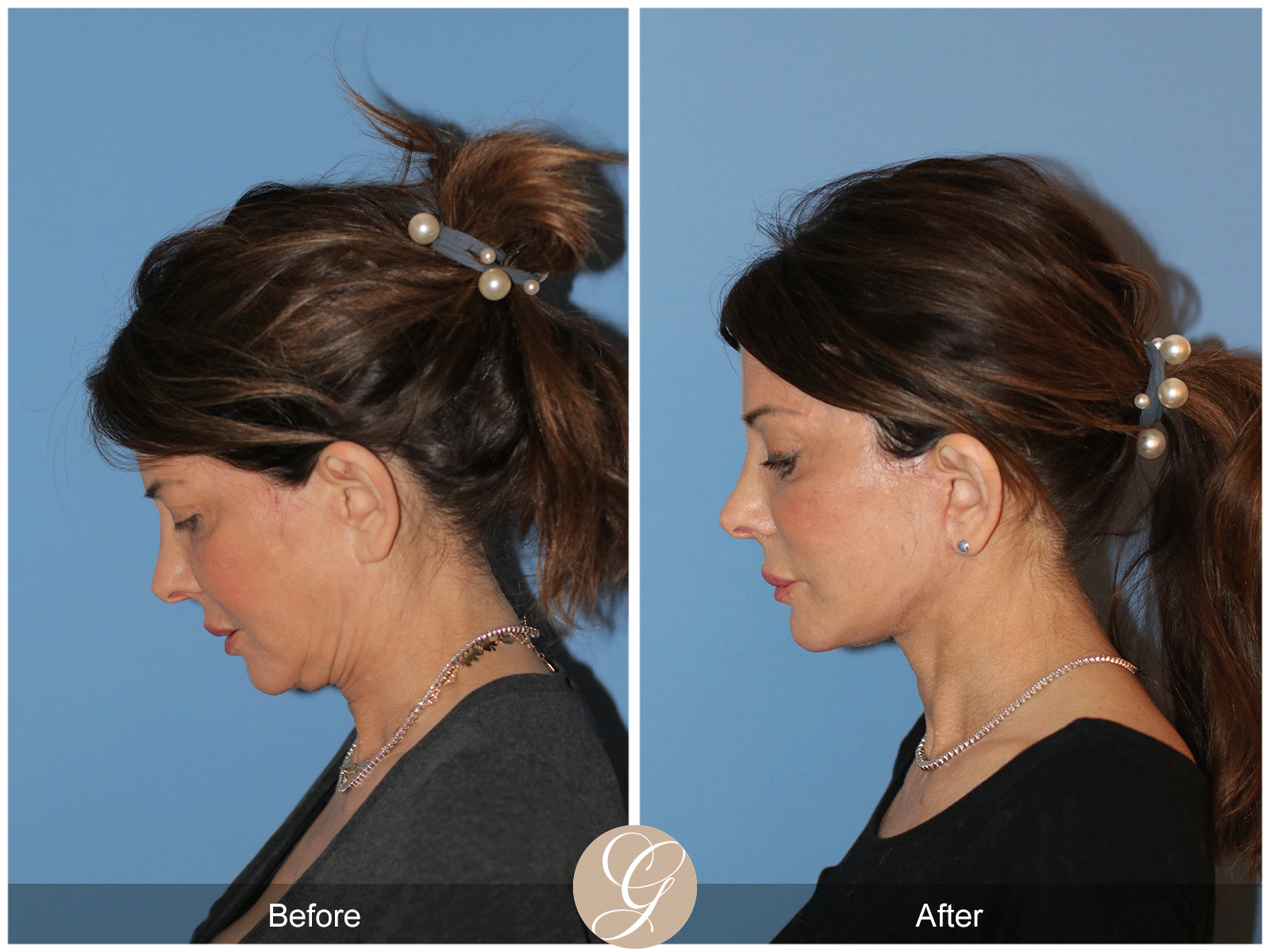 Preservation Deep Plane Facelift Case 27 Image