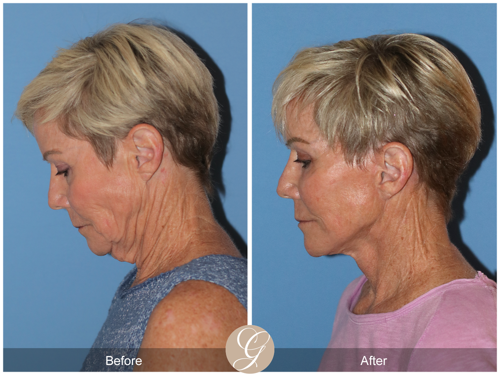 Preservation Deep Plane Facelift Case 28 Image