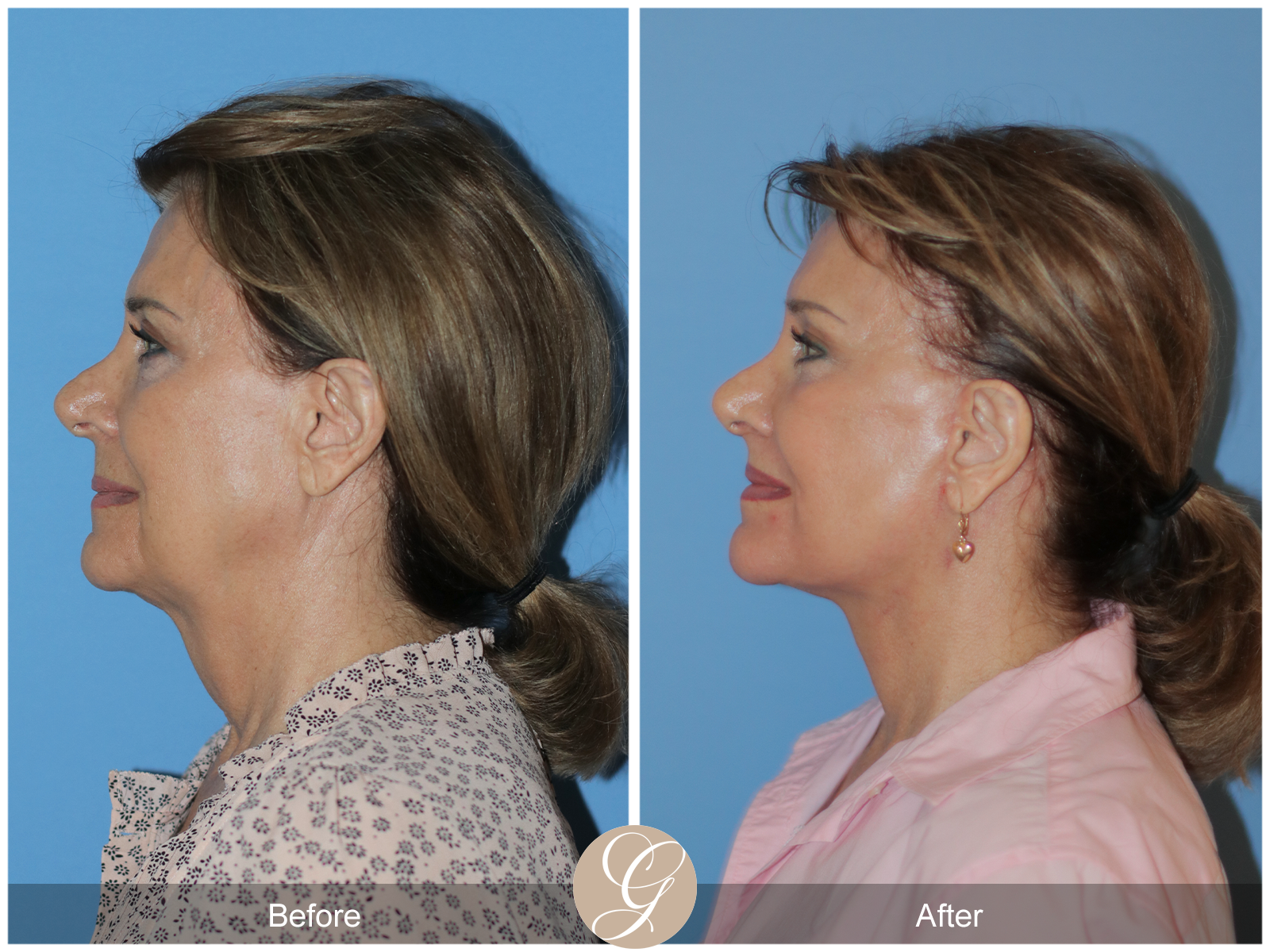 Preservation Deep Plane Facelift Case 30 Image