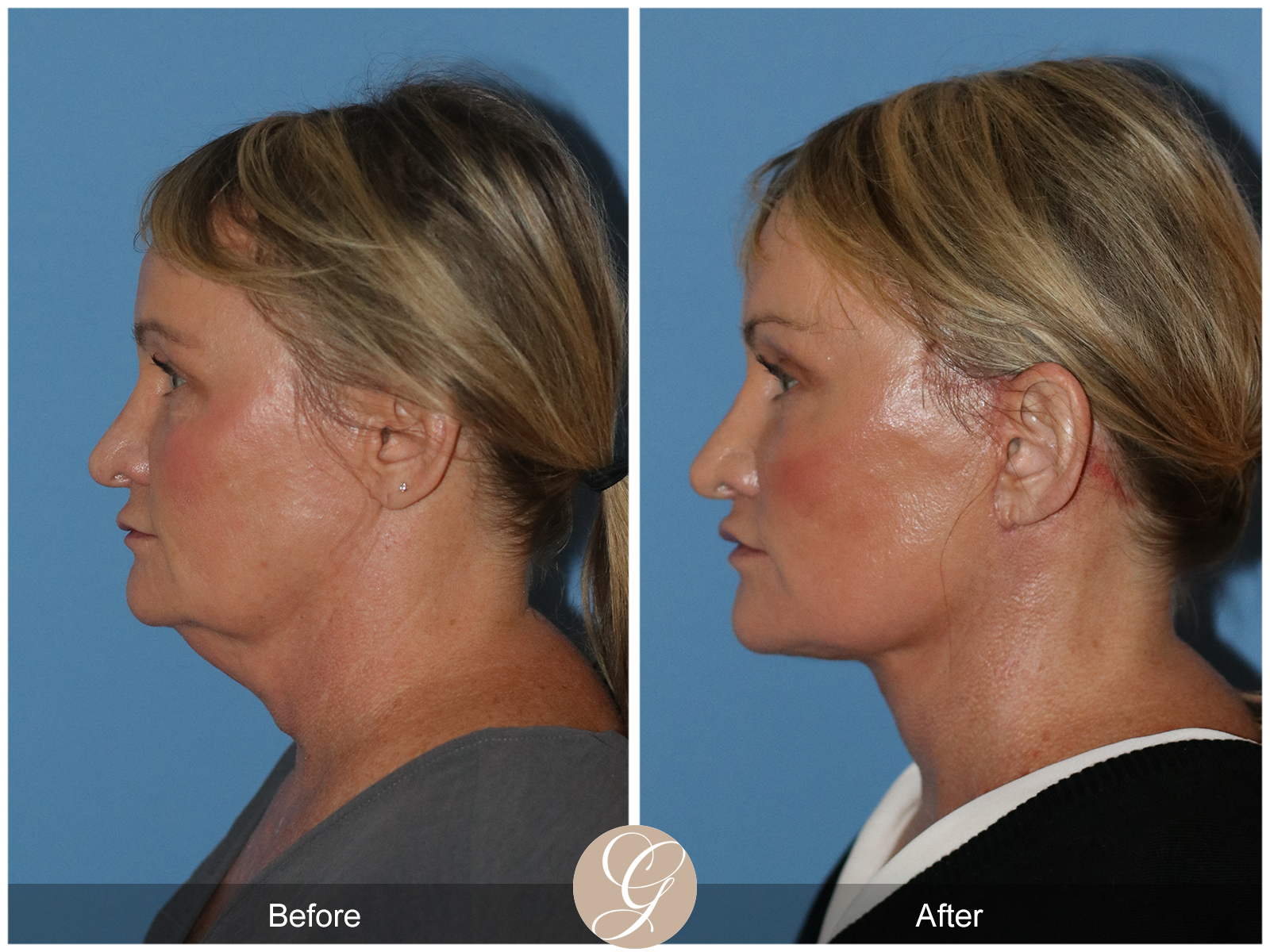 Preservation Deep Plane Facelift Case 34 Image