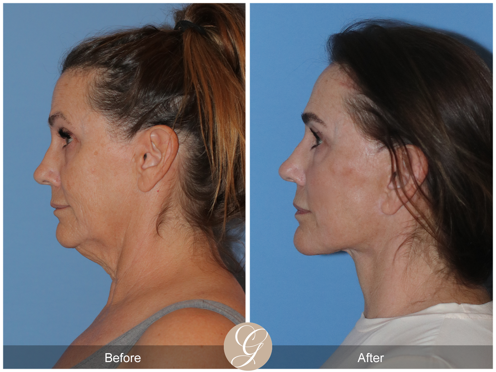 Deep Plane Facelift Case 25 Image