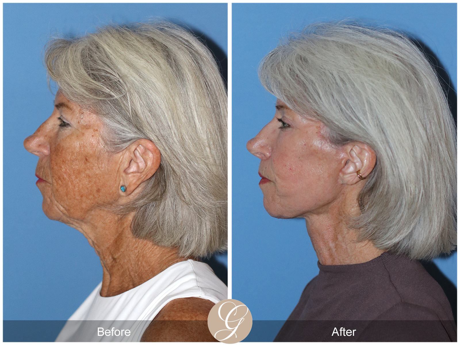 Preservation Deep Plane Facelift Case 24 Image