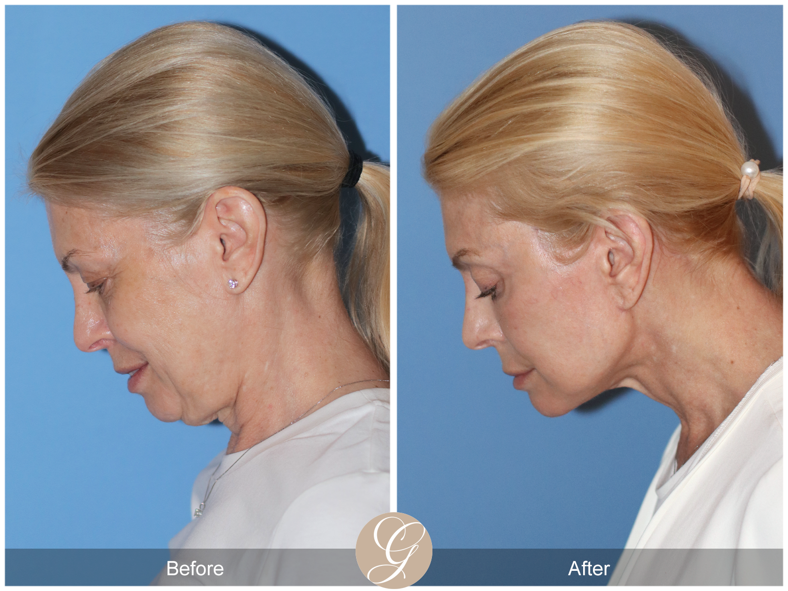 Preservation Deep Plane Facelift Case 26 Image