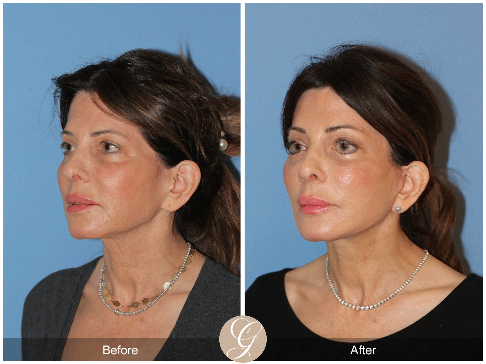 Preservation Deep Plane Facelift Case 27 Image