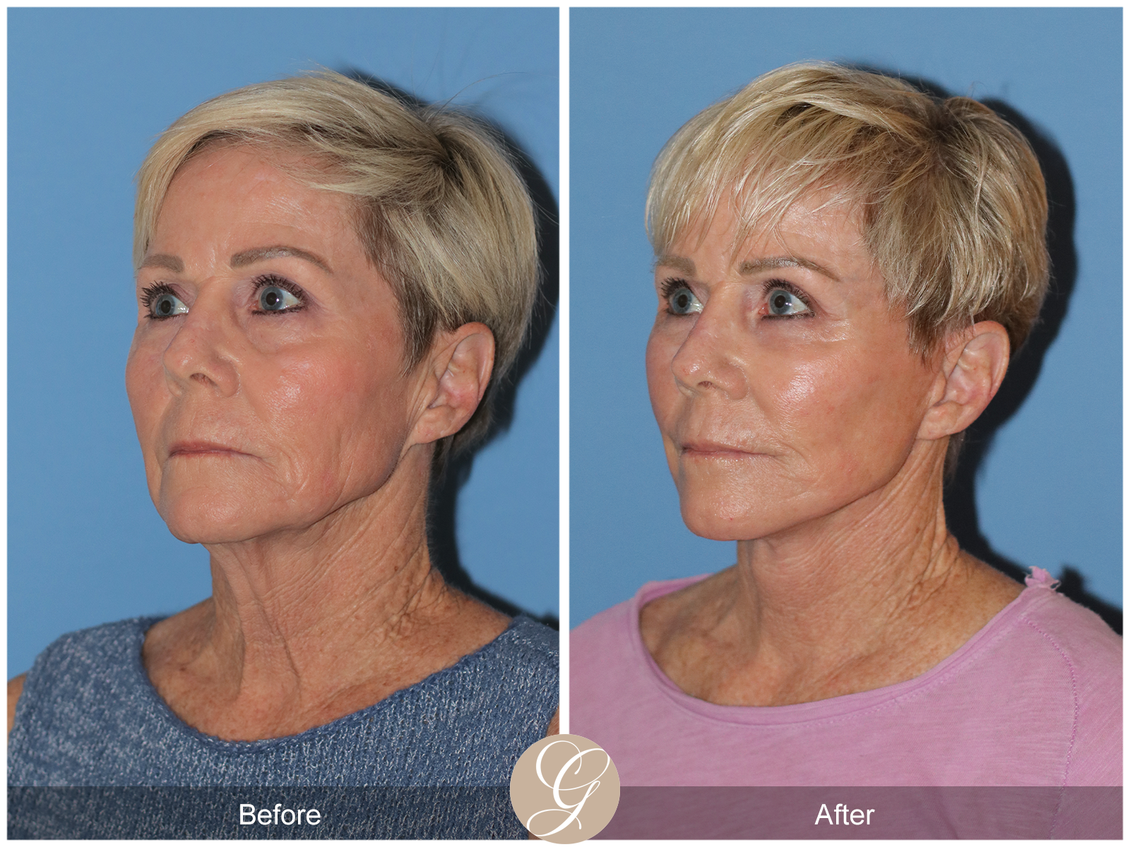 Preservation Deep Plane Facelift Case 28 Image