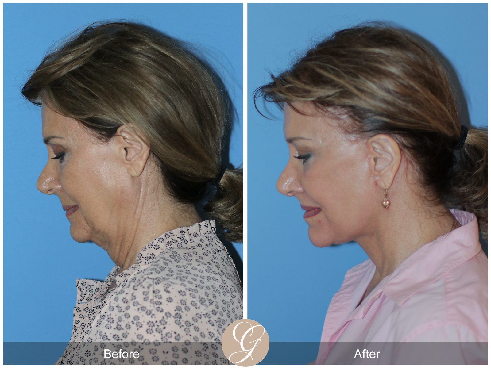 Preservation Deep Plane Facelift Case 30 Image