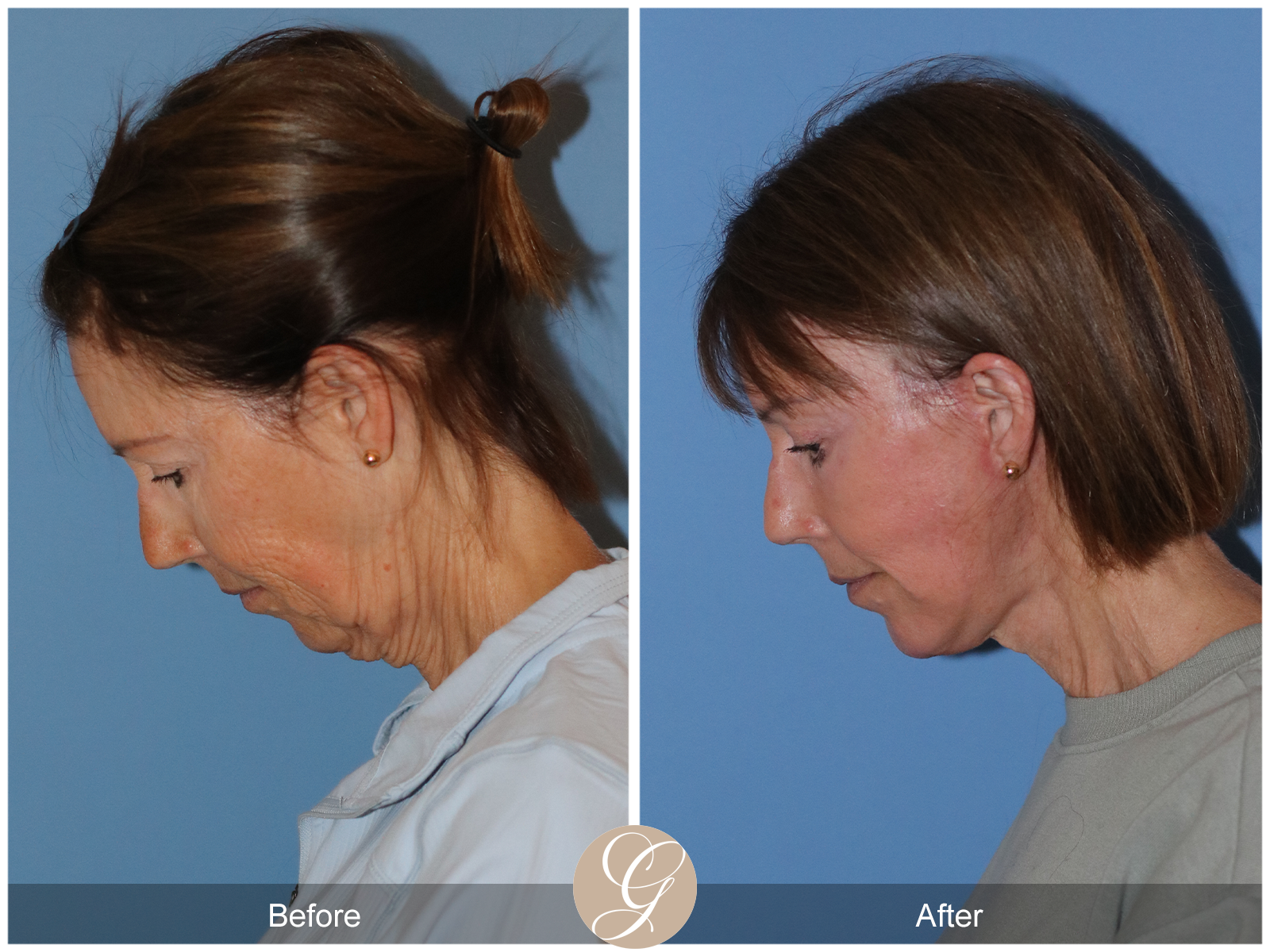 Preservation Deep Plane Facelift Case 32 Image