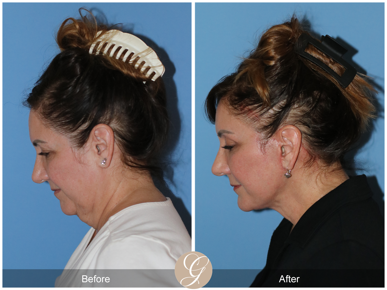 Preservation Deep Plane Facelift Case 33 Image