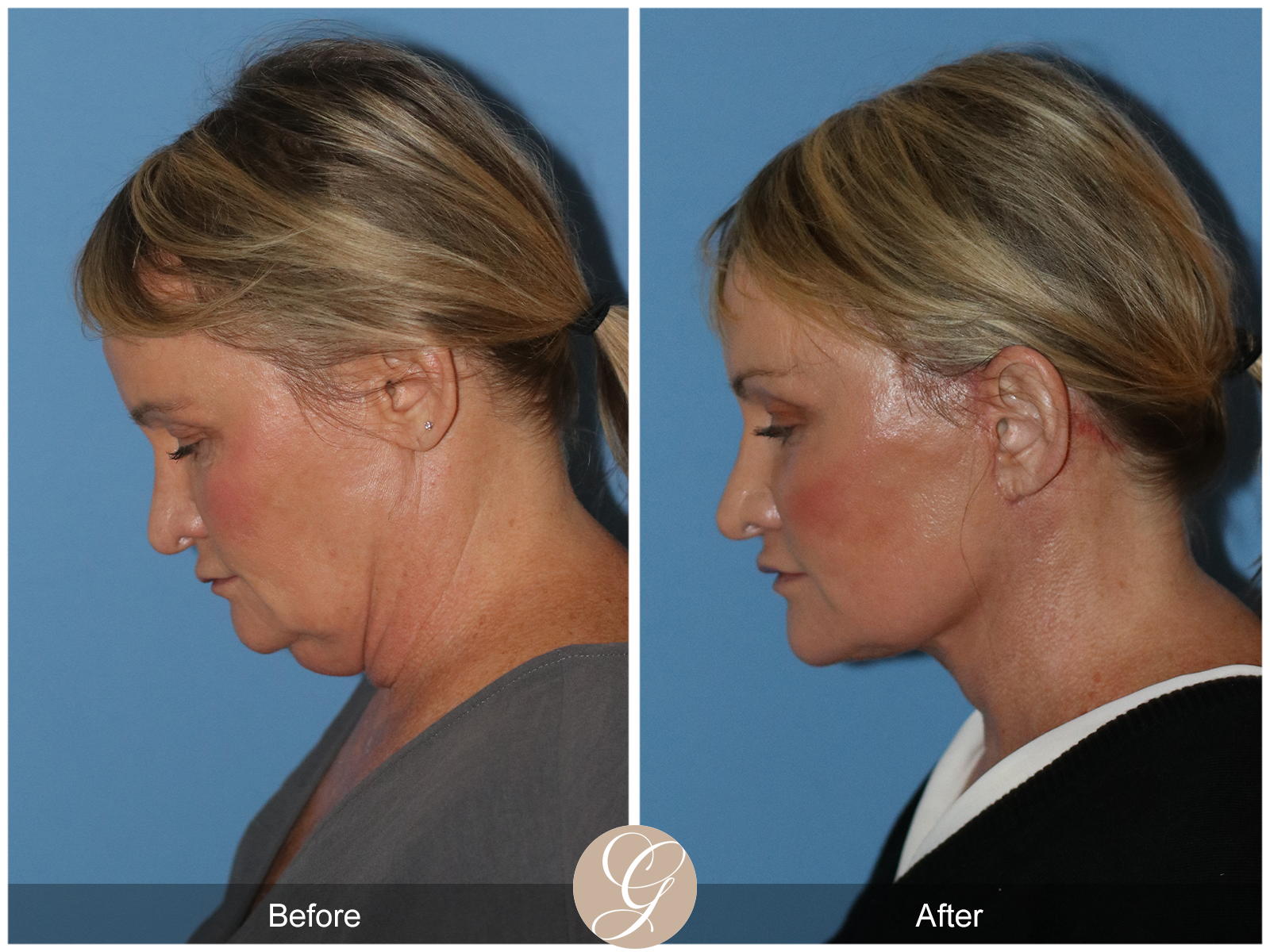 Preservation Deep Plane Facelift Case 34 Image