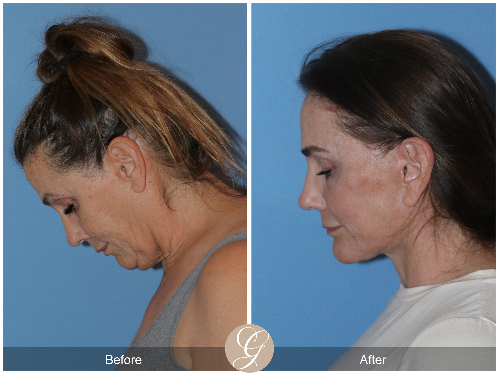 Deep Plane Facelift Case 25 Image