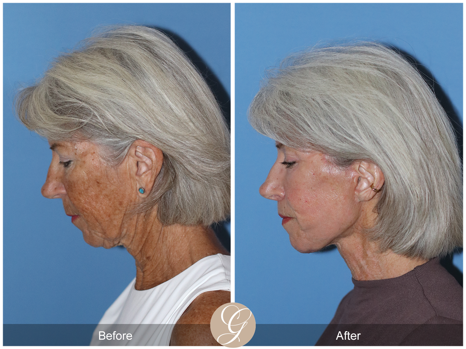 Preservation Deep Plane Facelift Case 24 Image