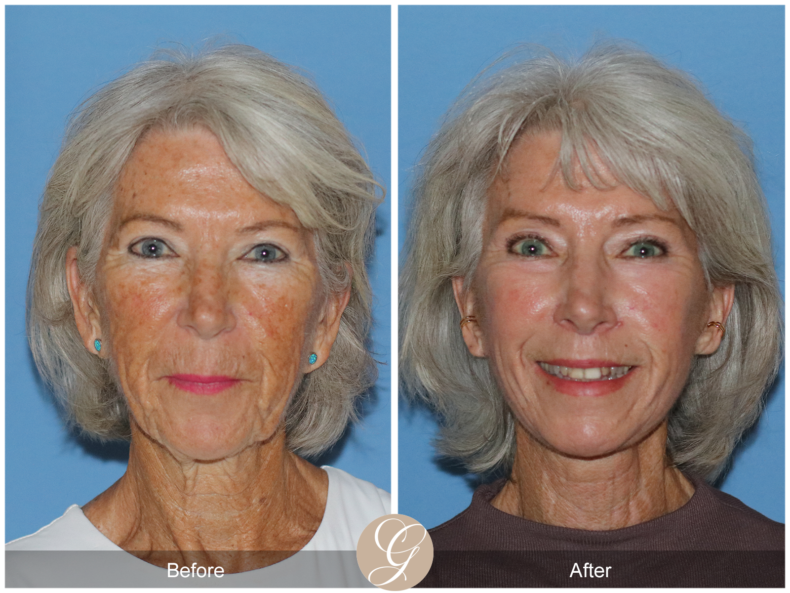 Preservation Deep Plane Facelift Case 24 Image