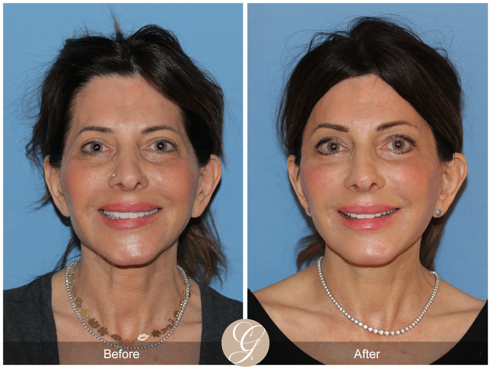 Preservation Deep Plane Facelift Case 27 Image